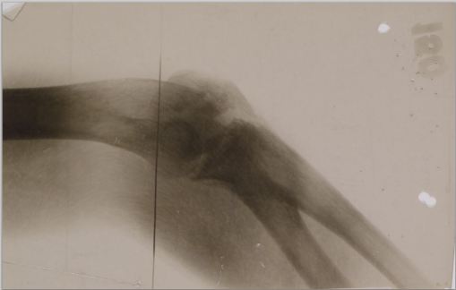 Xray image of Kerr's right arm