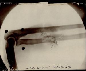 Harry Aylesworth x-ray