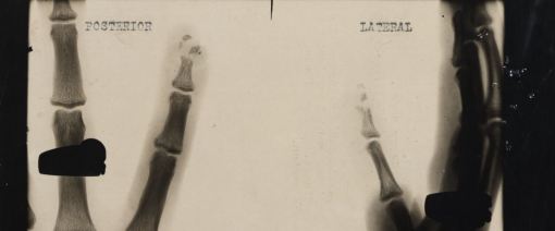 X-ray of Keith Sharpe's finger